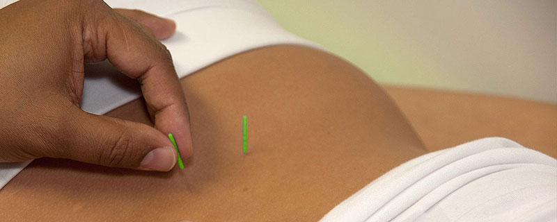 Akupunktur – kleine Nadel mit großer Wirkung. Schmerzlinderung Traditionell Chinesische Medizin TCM im Orthocentrum Hannover Laatzen
